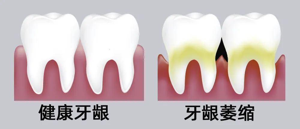 牙縫大露出“黑三角”，既塞牙又難看！還能恢復(fù)嗎？