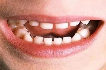 口腔健康，從娃娃抓起！6大兒牙常見問(wèn)題，家長(zhǎng)們要注意了！